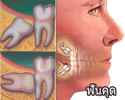 ฟันคุด เกิดจากฟันที่มีขนาดใหญ่กว่าเหงือก