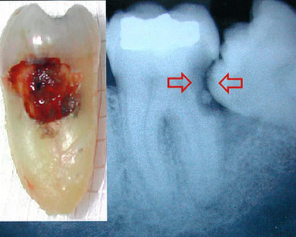 ฟันซี่ปกติข้างฟันคุดจะถูกเบียดจนเป็นแผล และผุได้