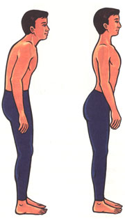 à¸à¸²à¸£à¸œà¸´à¸”รูปขà¸à¸‡à¸«à¸¥à¸±à¸‡ à¸à¸²à¸£à¸œà¸´à¸”รูปขà¸à¸‡à¸«à¸¥à¸±à¸‡