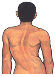 หลังคด หลังคด